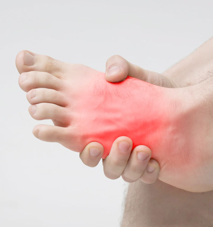 Neuroma de Morton e metatarsalgia causando dor e queimação na parte frontal do pé com tratamento especializado em Campinas